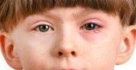 Красные глаза у детей