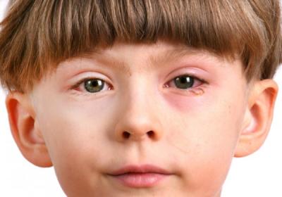 Красный глаз у ребенка: симптомы и причины