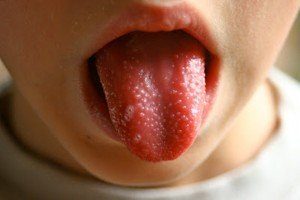 Скарлатина у детей: симптомы