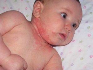Пищевая аллергия у детей: причины