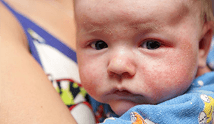 Методы лечения атопического дерматита у детей