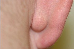 Шишка за ухом у ребёнка: причины