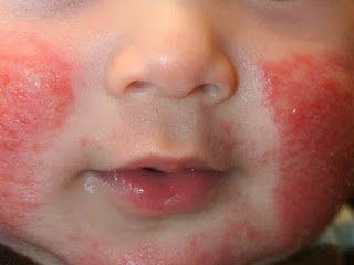 Холодовая аллергия у ребенка: как распознать?